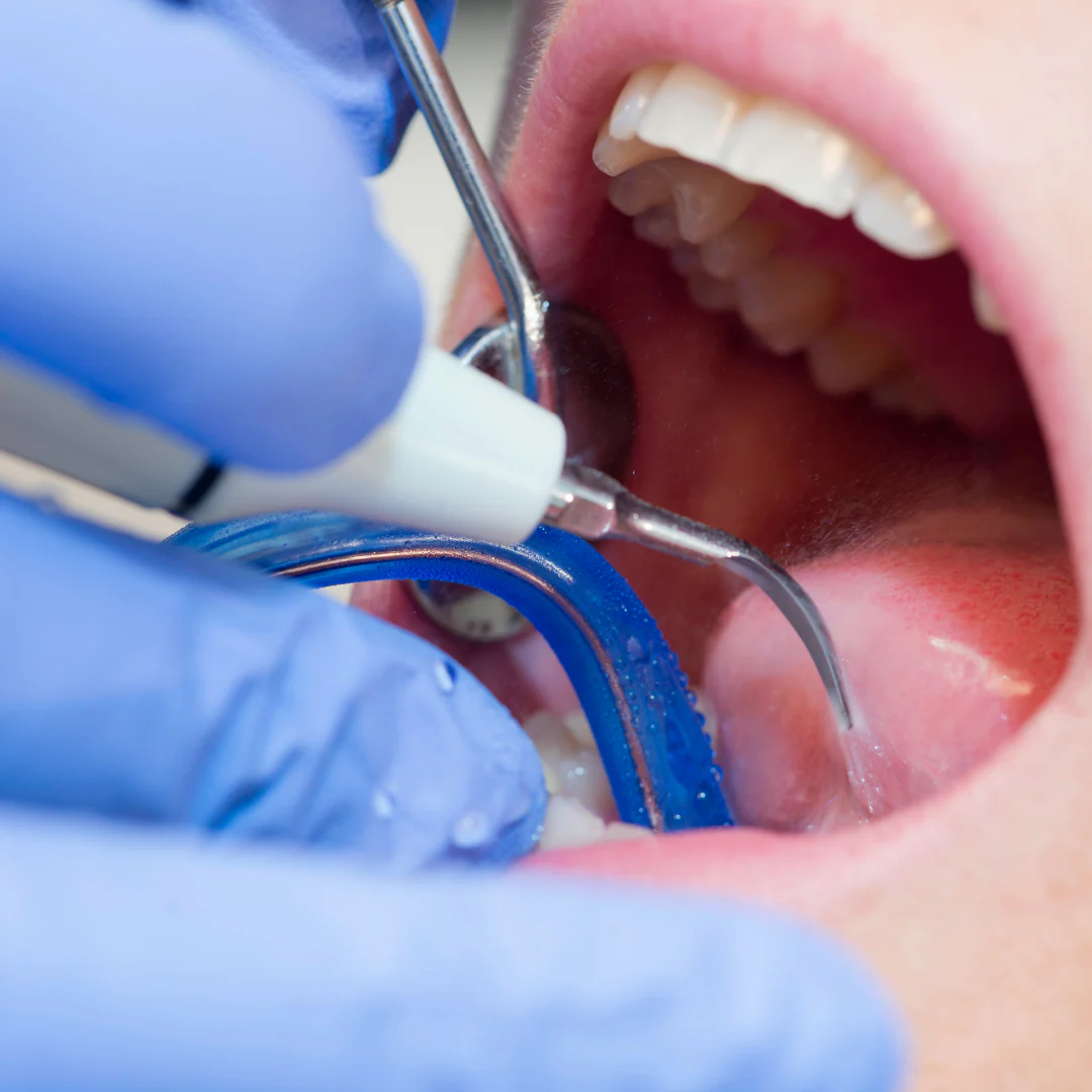Limpieza Dental Completa por solo $14 en Clínica Dental Metro - Image 2