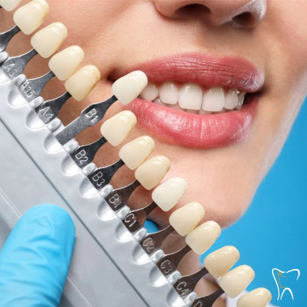 Blanqueamiento Dental Profesional + Limpieza + Evaluación por $75 en Total Care - Image 2
