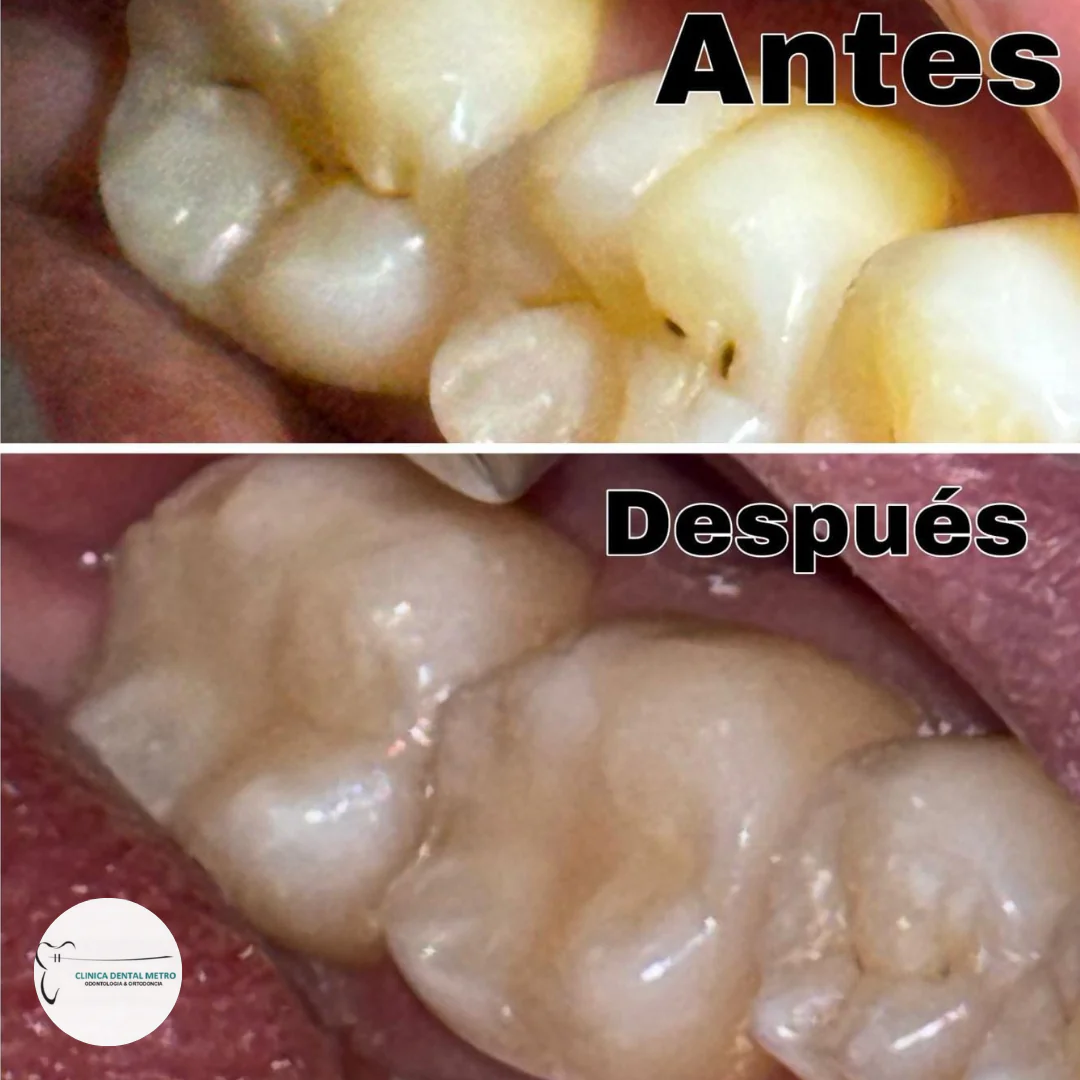 Remoción de Caries en dientes posteriores + Resina + Radiografía por solo $40 en Clínica Dental Metro - Image 2