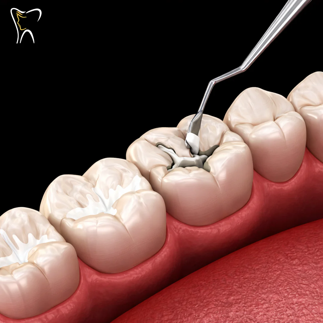Aplicación de Sellante Dental Preventivo de Caries + Evaluación Odontológica por $15 en Total Care